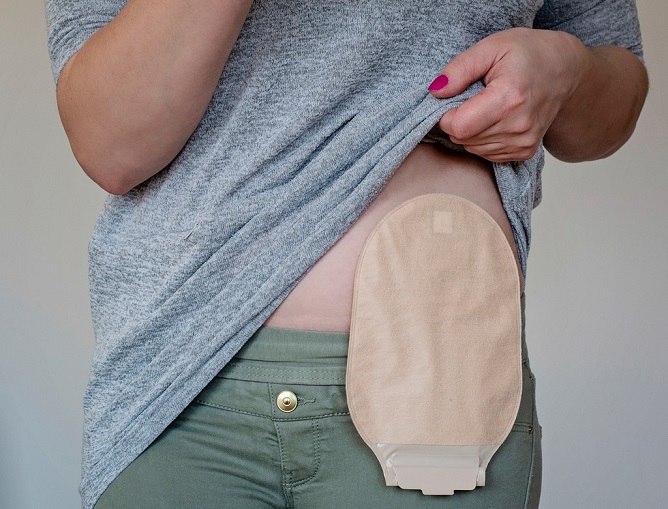 Living With An Ostomy And Managing It Well
